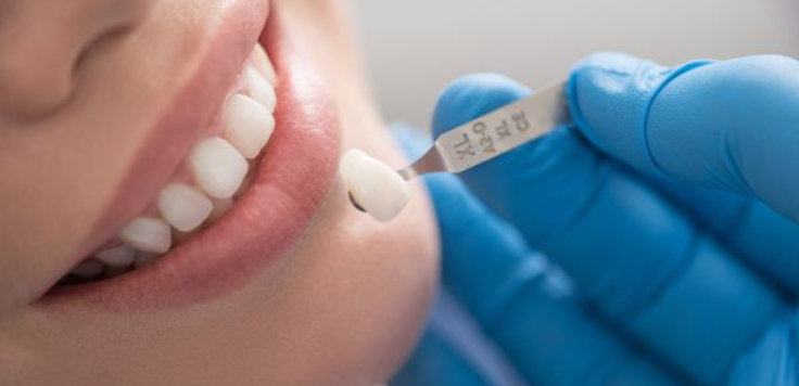 Dental laminates Navi Mumbai
